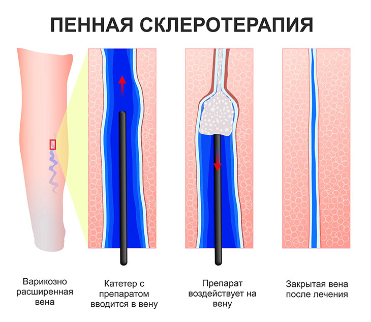 Склеротерапия варикозно расширенных вен в Днепре