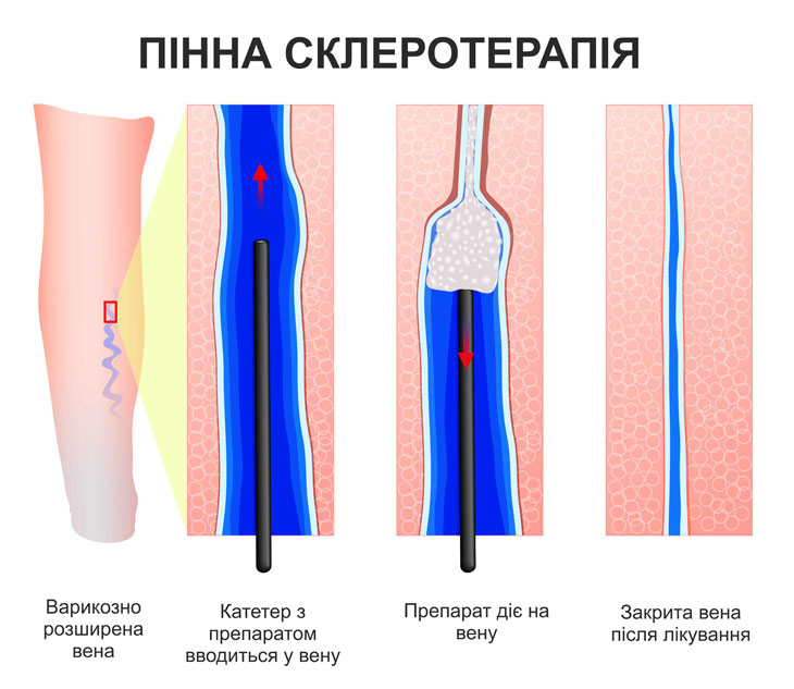 Склеротерапія варикозних розширених вен у Дніпрі